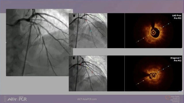 Treatment of calcified lesions
