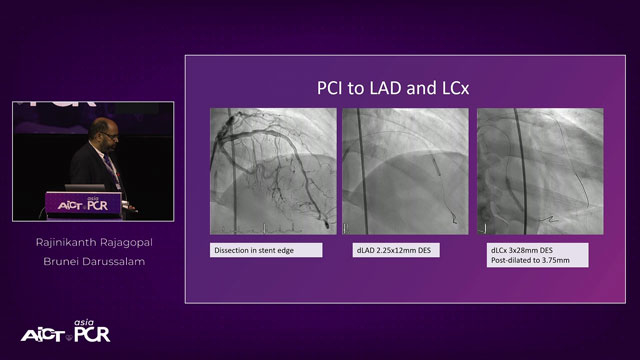 Treatment of small vessel disease - To stent or not to stent?