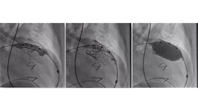 Tricuspid and pulmonary interventions