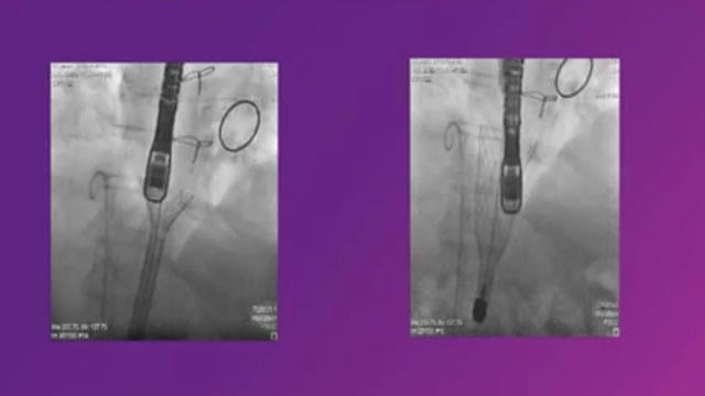 Tricuspid regurgitation : a new prospect in the management of patients with TR