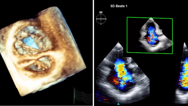 Tricuspid valve interventions in heart failure patients - Treatment optimisation and pre-procedural work-up