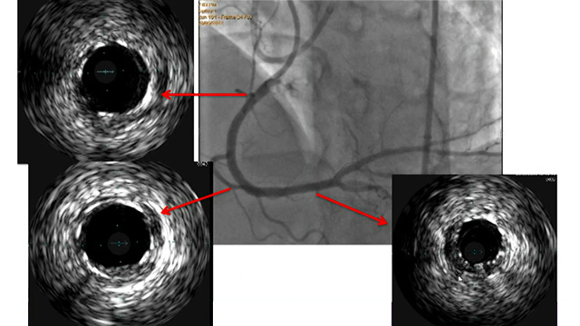 The use of ultra-low contrast in complex CTO