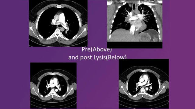 Ultrasound supported thrombolysis: a live-saving procedure in massive saddle pulmonary embolism