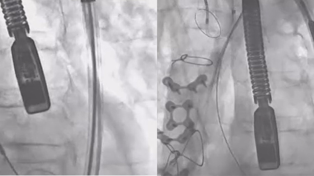 Valve-in-valve could be a challenging procedure