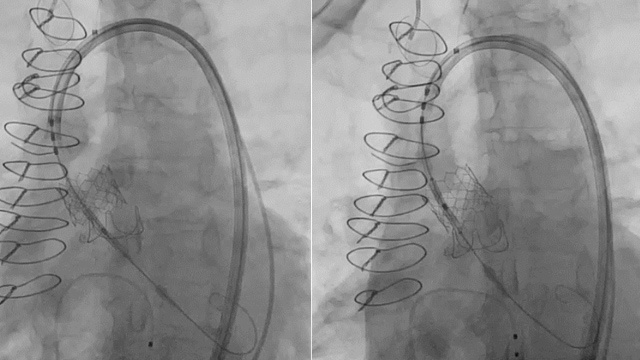 Valve-in-valve TAVI: Session 2