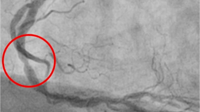 What's new in treatment of stent failure -  a closer look at stent restenosis and thrombosis
