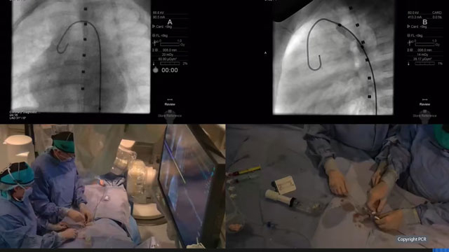 Coarctation of aorta, balloon angioplasty of recurrent coarctation following surgical repair
