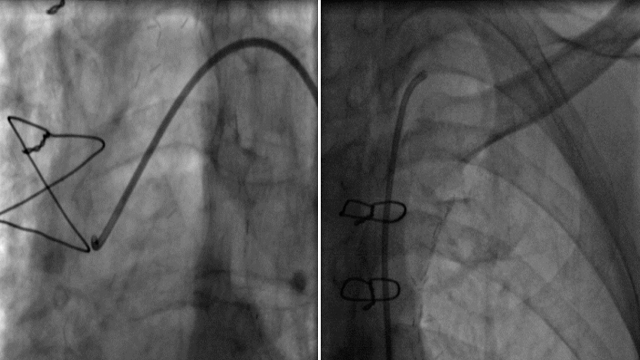 Advanced techniques for managing calcified lesions