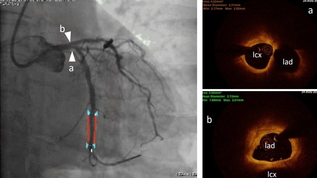 Calcified lesions complications