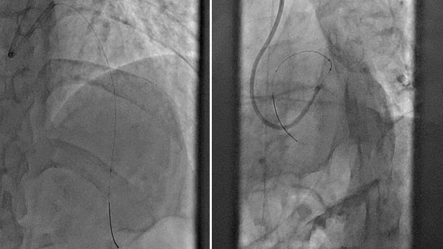 Complex STEMI cases