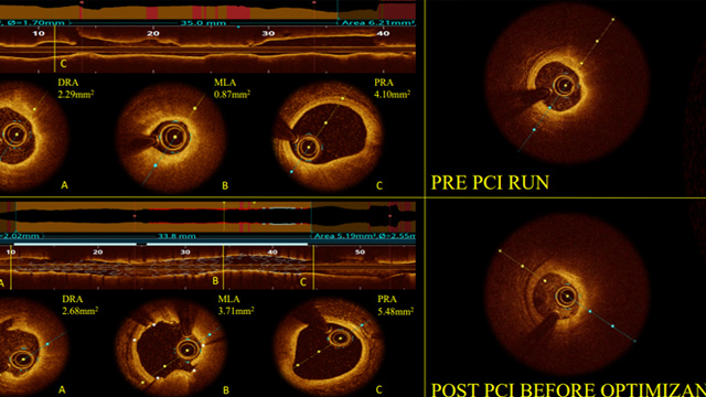Contrast-less PCI