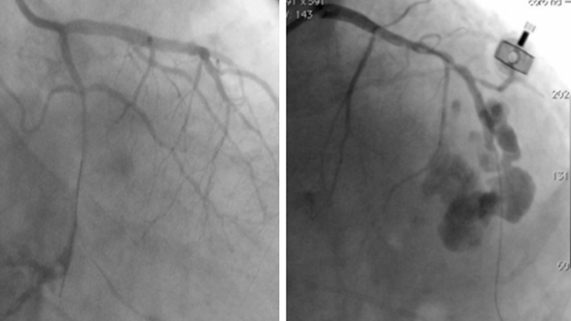Coronary and vascular complications