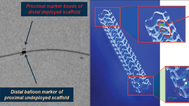 Exploring advancements in drug-coated balloons (DCB)