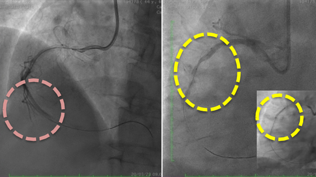 Innovations in managing calcified lesions