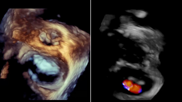 Innovations in TAVI and mitral interventions