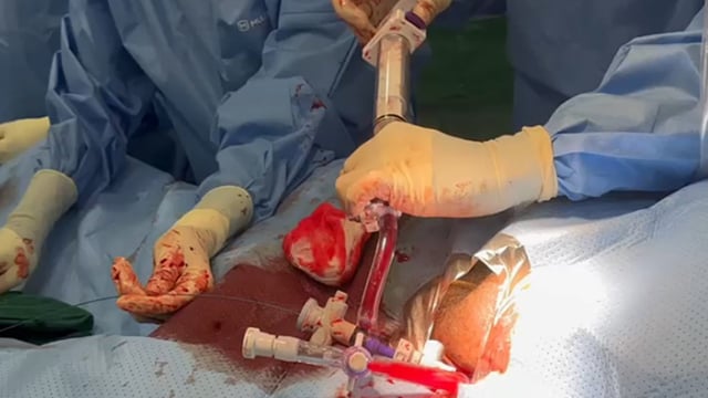 Learning - Percutaneous management of pulmonary embolism