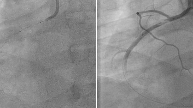 Navigating complex STEMI situations
