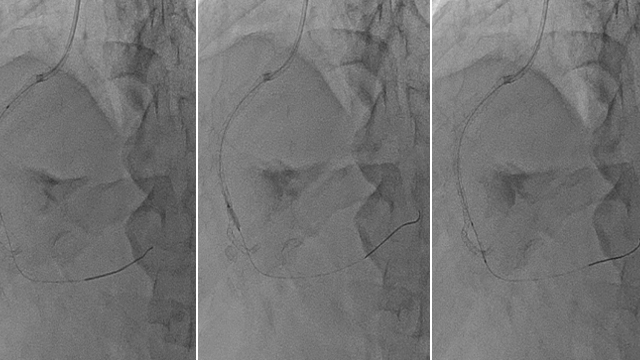 NSTEMI: lessons from real cases