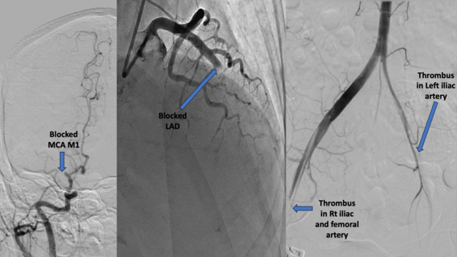 STEMI complications and beyond