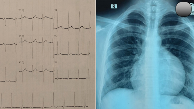 Sudden heart failure, unusual echo findings and the role of interventional radiologists