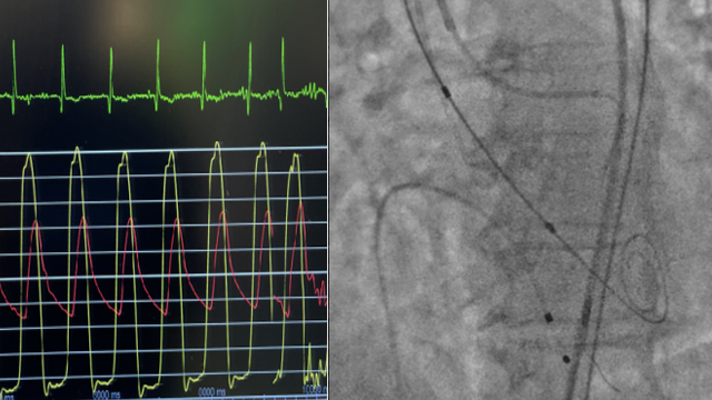 TAVI Insights: Addressing challenges and complex cases