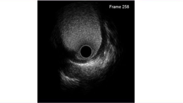 Coronary imaging in the structural cathlab