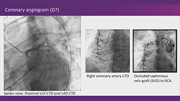 ACS: when a CABG is involved