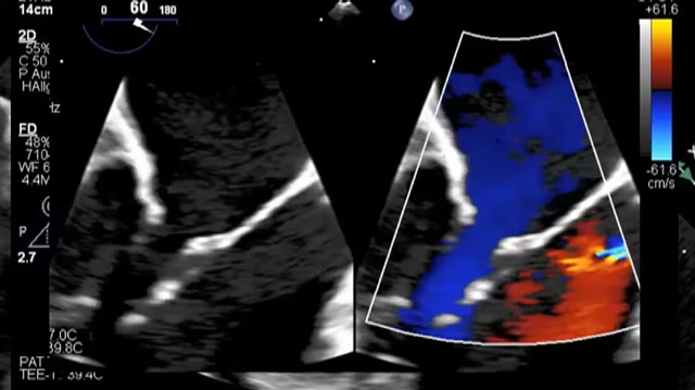 All you need to know about transcatheter treatment solutions for mitral regurgitation