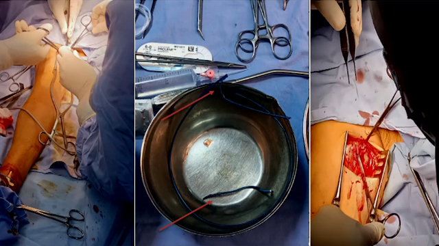 Bailouts for PCI complications