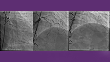Bifurcation PCI