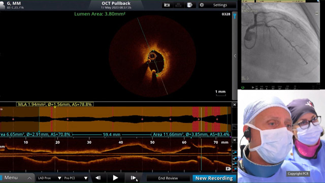 Bifurcation with provisional stent strategy - LIVE case