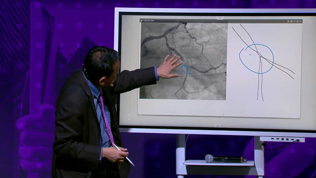 Can we use provisional stent strategy in complex bifurcation lesions?