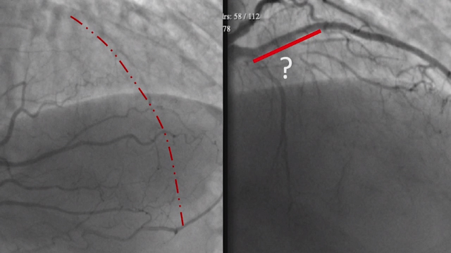 Challenges in retrograde CTO procedures