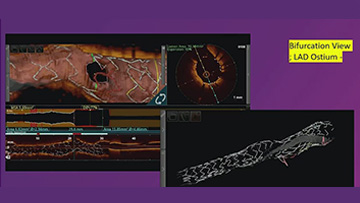 Challenging PCI in complex coronary anatomy