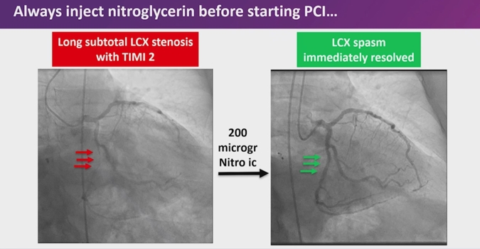 Complex atrial septal intervention
