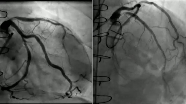 Complex PCI cases