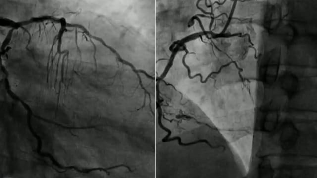 Complications in bifurcation lesions