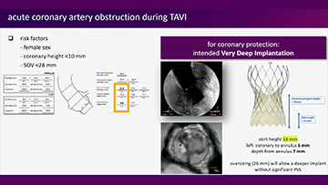 Coronary obstruction post TAVI