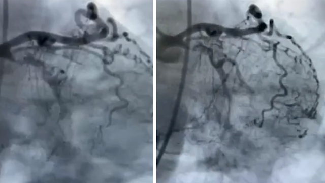 CTO complications