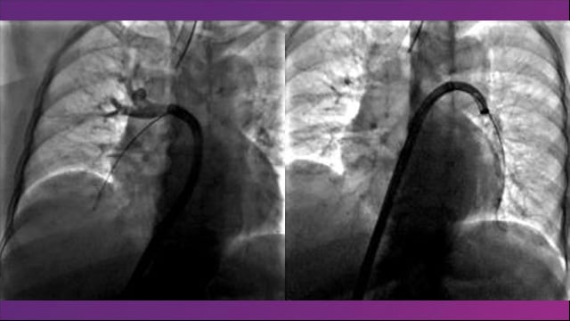 Current trends in the invasive treatment of pulmonary embolism