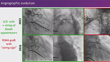  Intracoronary imaging for CTO-PCI decision-making