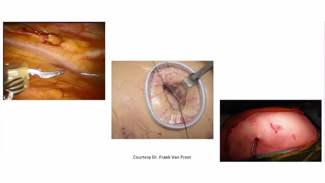 Diagnosis and procedural strategies for severely calcified lesions