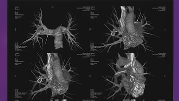 Endovascular management for pulmonary embolism