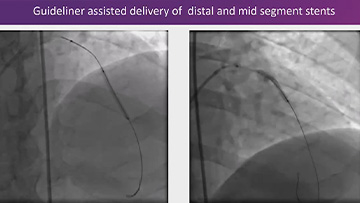 Fighting against a rock - CTO and calcification