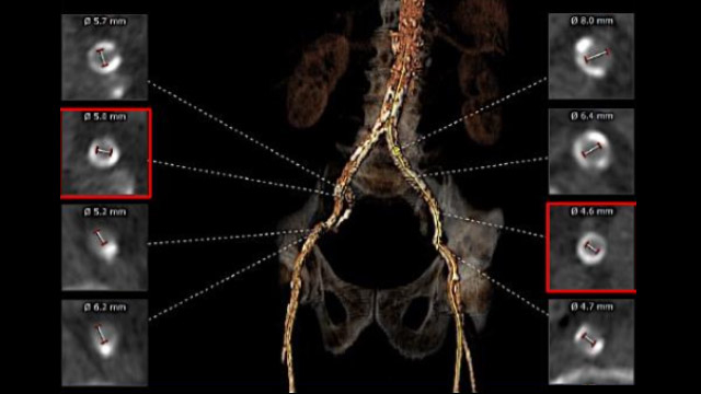 Hostile vascular access for large catheters