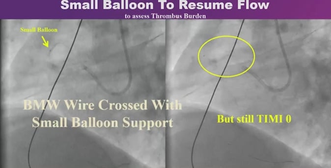 How to treat coronary aneurysm