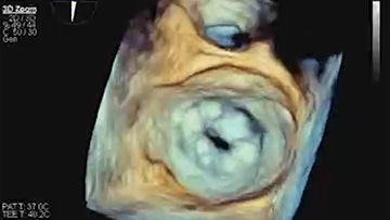 Multivalvular coronary interventions