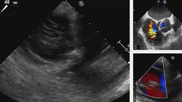 Tricuspid valve therapies in interventional cardiology