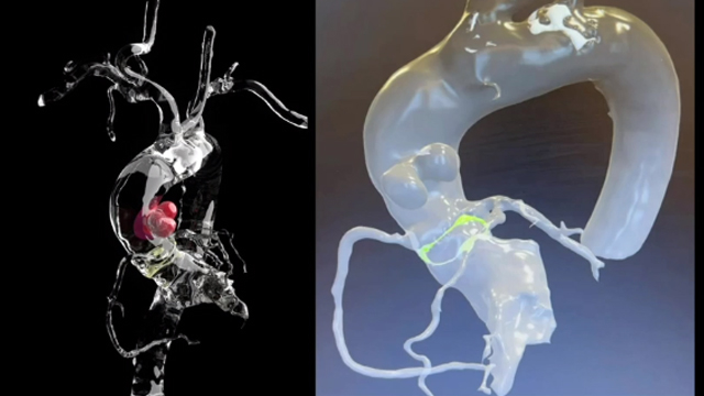 Interventional solutions for post-surgical problems