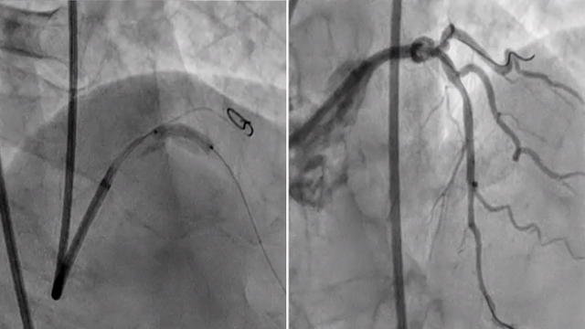 Intracoronary imaging in left main - Part 1